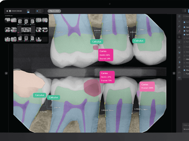Pearl Second Opinion® Dental AI Platform